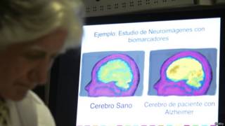 Foto de cerebro afectado por Alzheimer