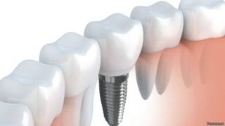 Implante dental