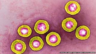 virus del herpes
