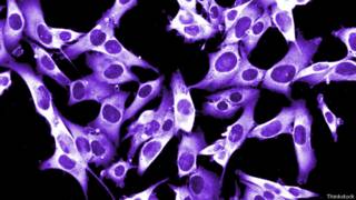 Melanoma