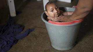 Wani yaro da ya kamu da kwayar cutar Zika a Brazil