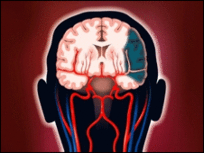 que ocasiona una trombosis cerebral que ocasiona una trombosis cerebral