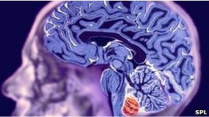 ¿Pueden los aneurismas cerebrales causar presión arterial alta?