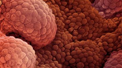Resultados de la prueba de cáncer de próstata pca3
