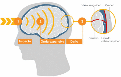 Hinchazón cerebral después de los síntomas de lesión en la cabeza