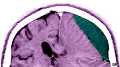 Hinchazón cerebral después de un trauma