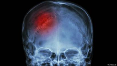 ¿Puede una conmoción cerebral causar un coágulo de sangre?