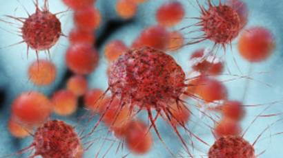 cáncer de próstata maligno cuando va a los huesos medicitalia cáncer de próstata maligno cuando va a los huesos medicitalia