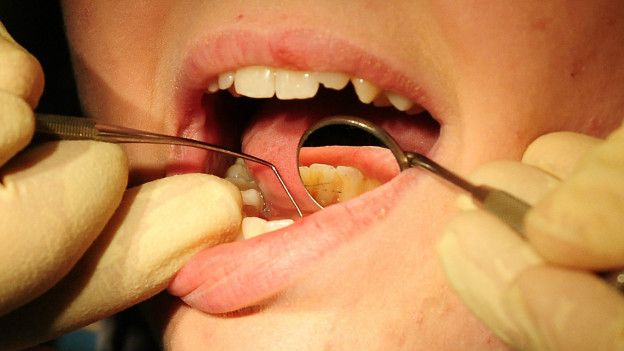El 40% de los futbolistas profesionales tienen caries, en comparación con el 30% de la gente de la misma edad. Dentista