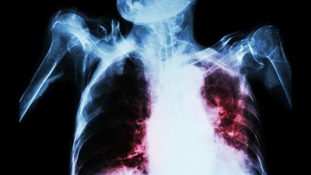 Tuberculosis