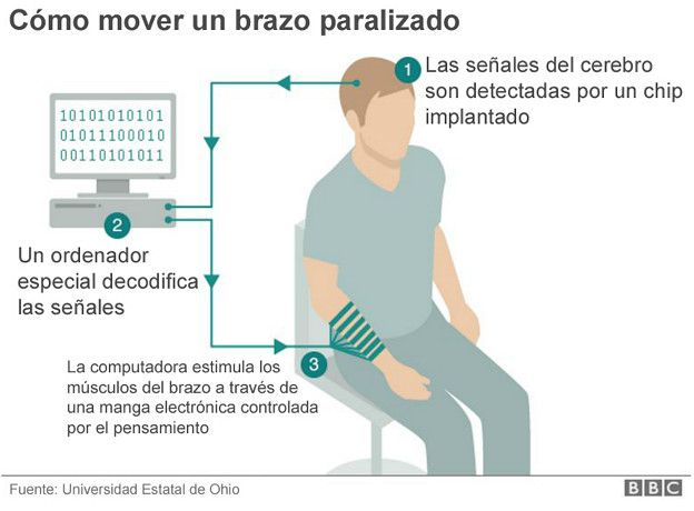 Infograma sobre cómo mover un brazo paralizado