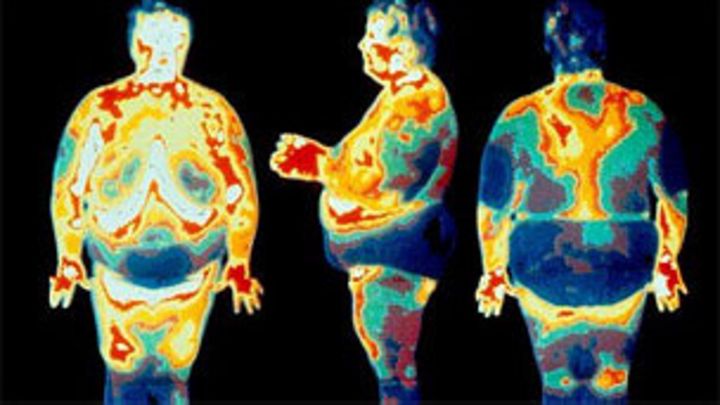 Los Riesgos De La Cirugia Bariatrica Bbc News Mundo