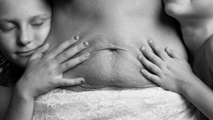 como quitar lo negro de la barriga despues del embarazo