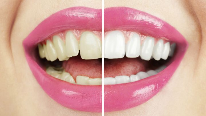 Recetas caseras para blanquear los dientes postizos