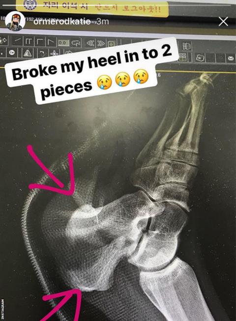 Katie Ormerod X-Ray