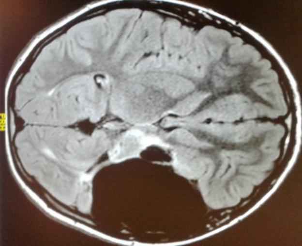 Hayley Milne brain scan