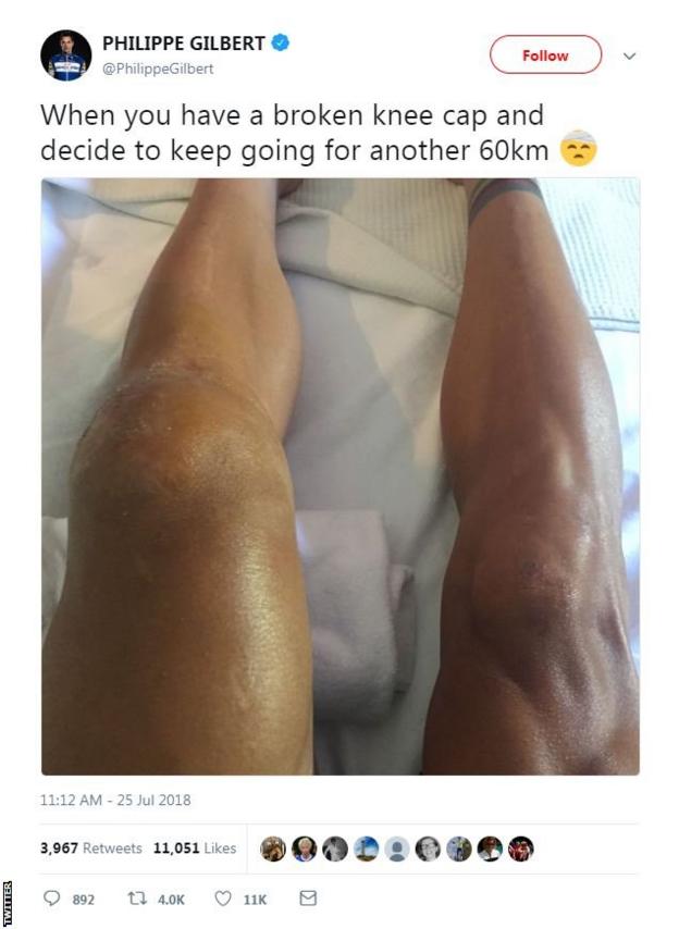 Philippe Gilbert Tweets a picture of his knee