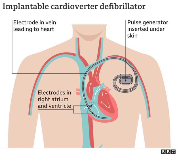 ICD graphic