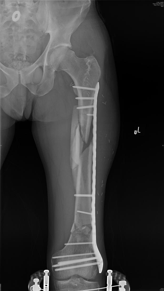 Ian Hutchinson's femur