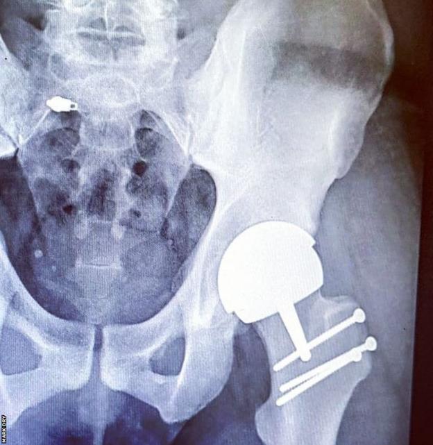 X-ray