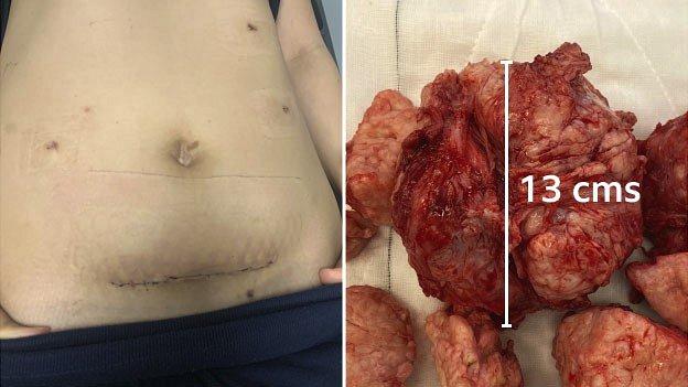 A picture showing the scarring and tumours of Magdalena Moshi's body