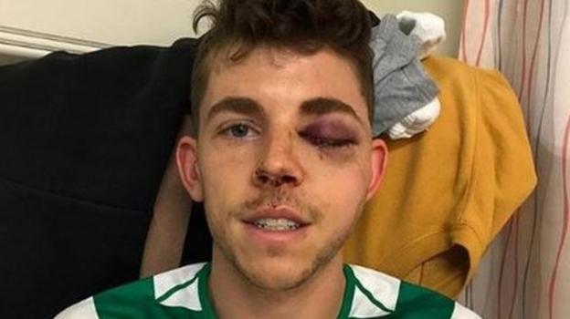 Celtic: Ryan Christie set for surgery after suffering multiple ‘facial fractures’