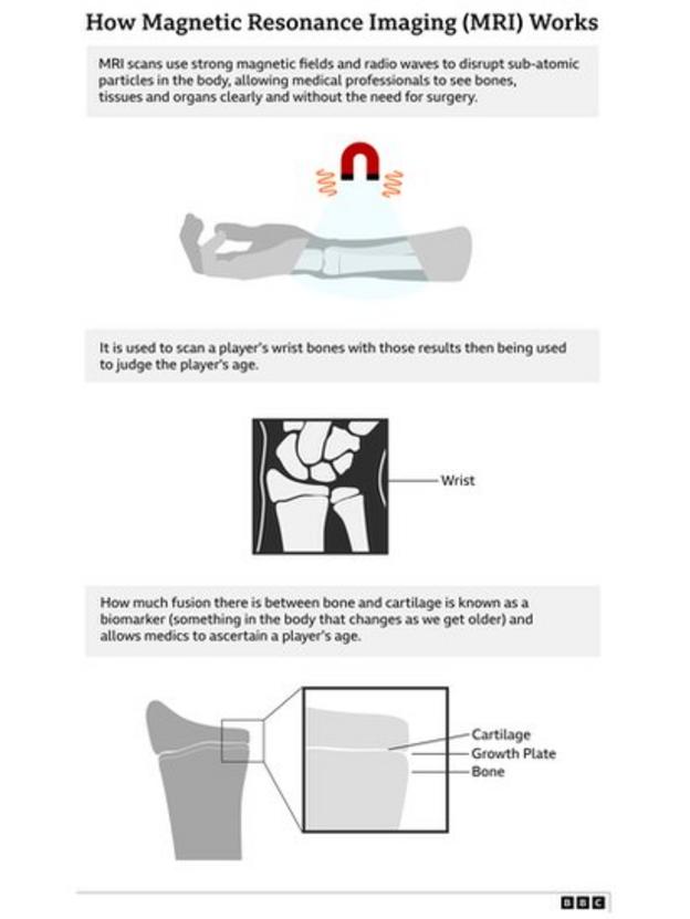 Graphic explaining how MRI scans test a soccer player's wrist bone