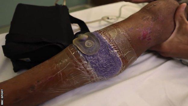 James Ellington's leg