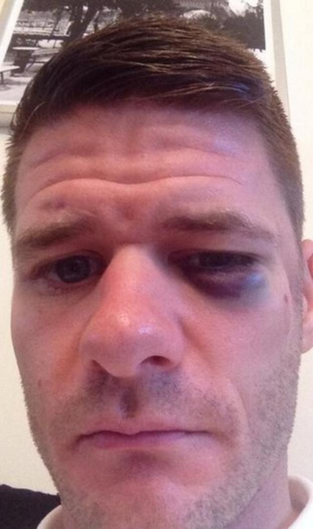 Michael Nelson's picture of his black eye