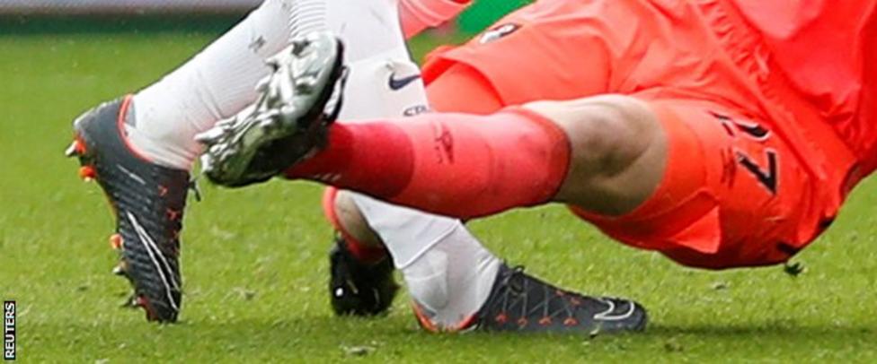 _100369386_harrykaneinjury.jpg