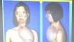 Una niña china de 17 años se somete a un transplante de cara 