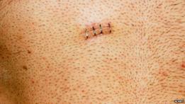 Cicatriz de extracción de vesícula