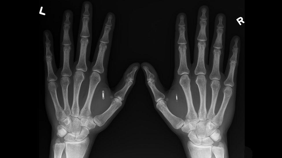 Many people now have chips implanted in the fleshy part between thumb and index finger. (Amal Graafstra/Dangerous Things) Many people now have chips implanted in the fleshy part between thumb and index finger. (Amal Graafstra/Dangerous Things)