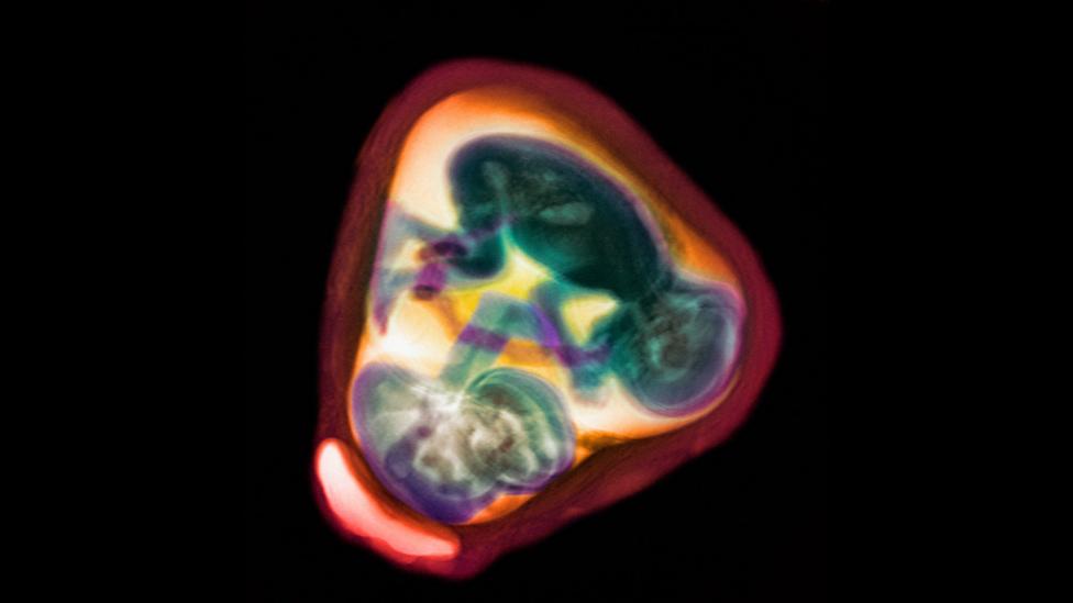 Multiple twins or triplets could in principle allow for high numbers of children, but the health risks are great (Credit: SPL) Multiple twins or triplets could in principle allow for high numbers of children, but the health risks are great (Credit: SPL)