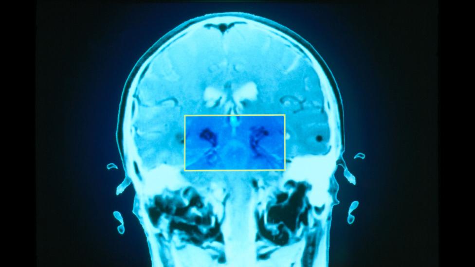 Fatigue may arise from damage to the basal ganglia, highlighted here in the brain of someone with Parkinson's disease (Credit: Science Photo Library) Fatigue may arise from damage to the basal ganglia, highlighted here in the brain of someone with Parkinson's disease (Credit: Science Photo Library)